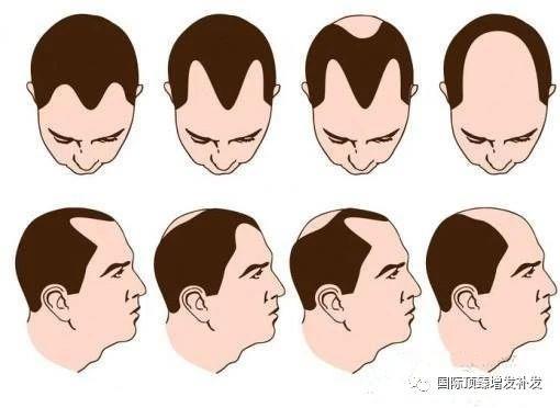 國際頂臻美學增發(fā)補發(fā) 雄激素脫發(fā)原因是啥